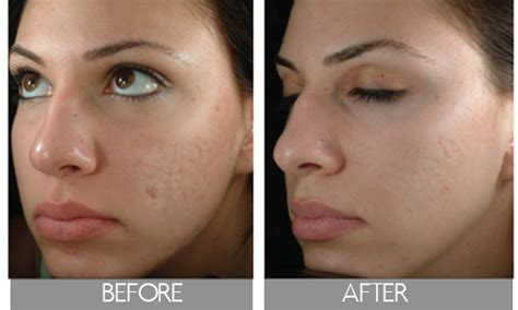 Facial scar healing - Adult archive Facial scar healing Adult archive